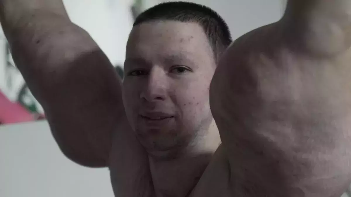 Synthol Kid :  Les terribles effets secondaires chez le fou qui s'injectait du Synthol pour avoir des bras à la Popeye