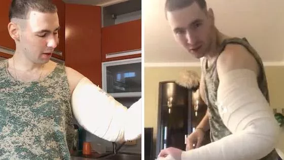 Synthol Kid s'est fait opérer des bras et nous montre l'effrayant résultat